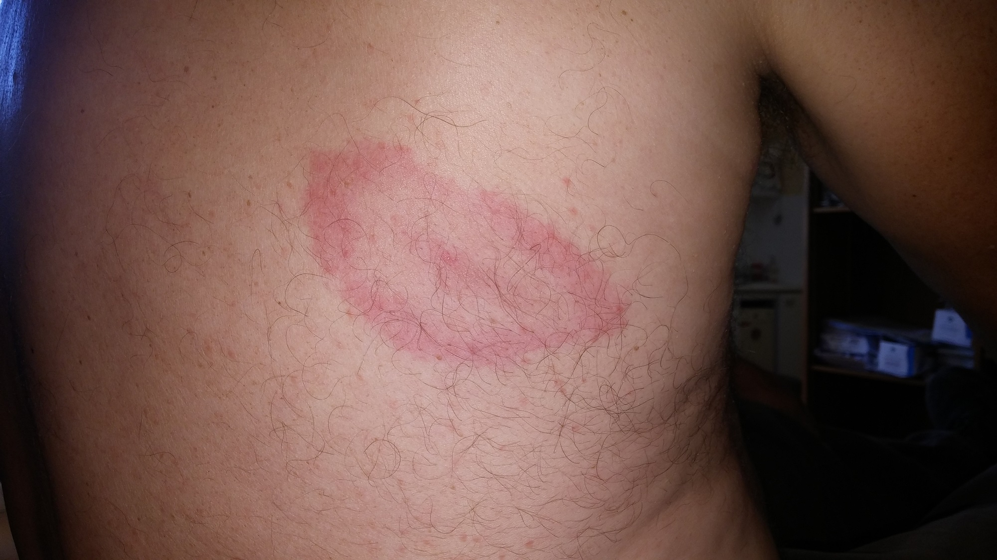 Plaque rouge apparaissant suite à une morsure de tique, symptôme de la maladie de Lyme