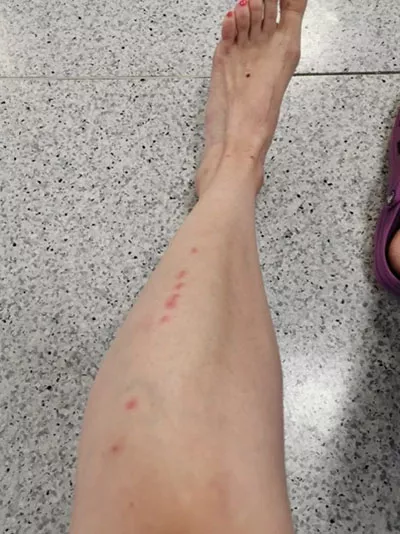 Piqures de punaises sur une jambe Se reporter à la légende pour le copyright