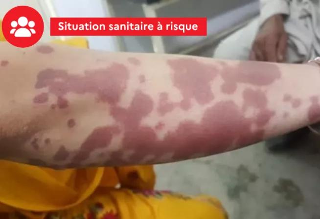 Situation sanitaire à risque