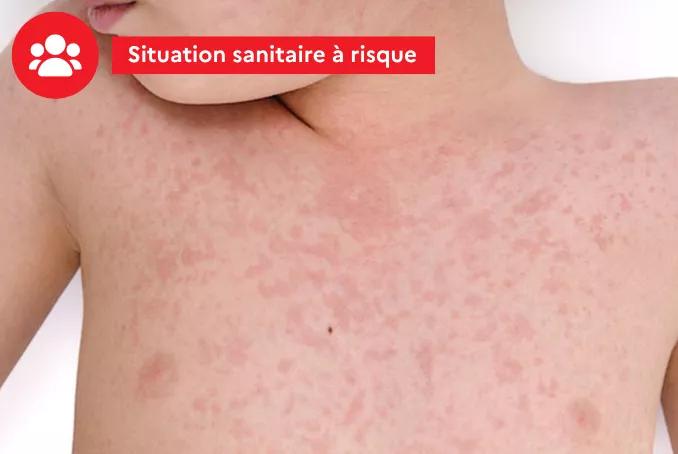 Situation sanitaire à risque